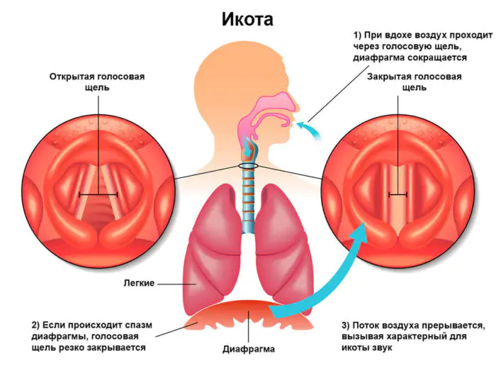 Как избавиться от икоты: проверенные методы и советы Как избавиться от икоты: проверенные методы и советы