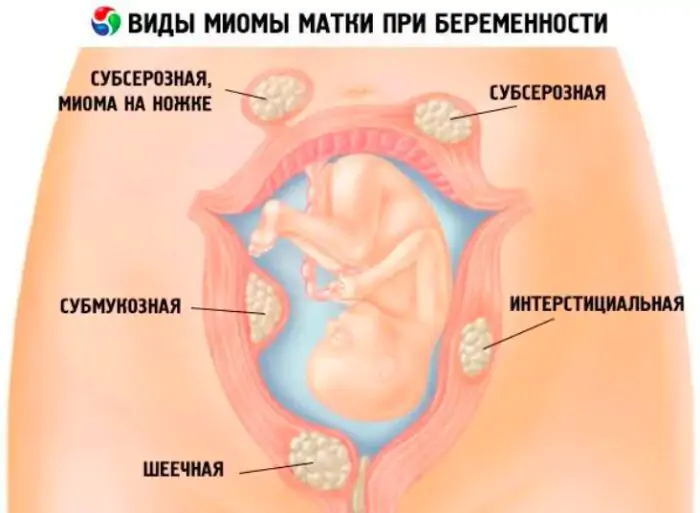 Особенности наблюдения при миоме матки при беременности